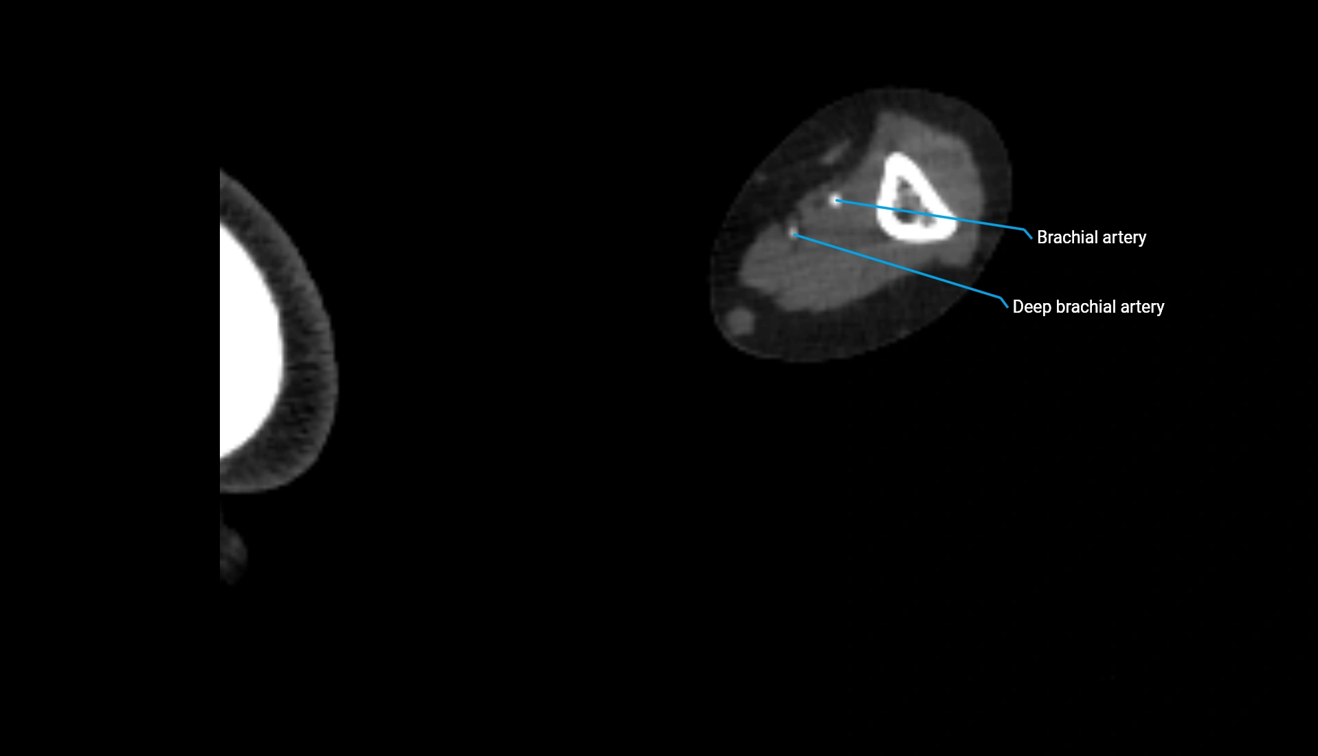 CTA upper limb axial cross sectional anatomy labelled image 209 (2).webp